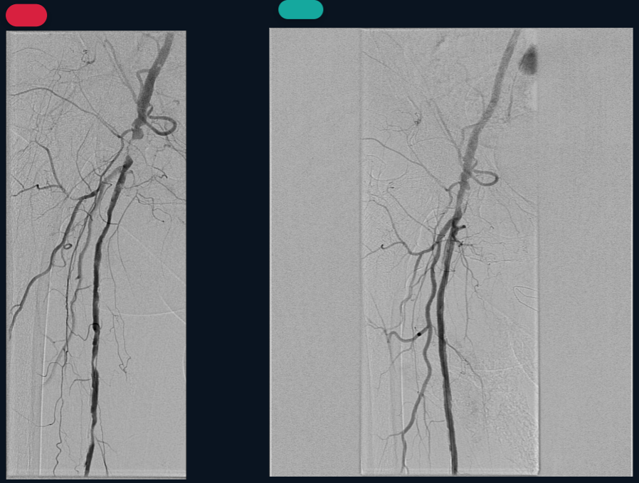 MID – ATP de FeCo com DEB, FeSup com implante de Stent biomimético e Ta ​