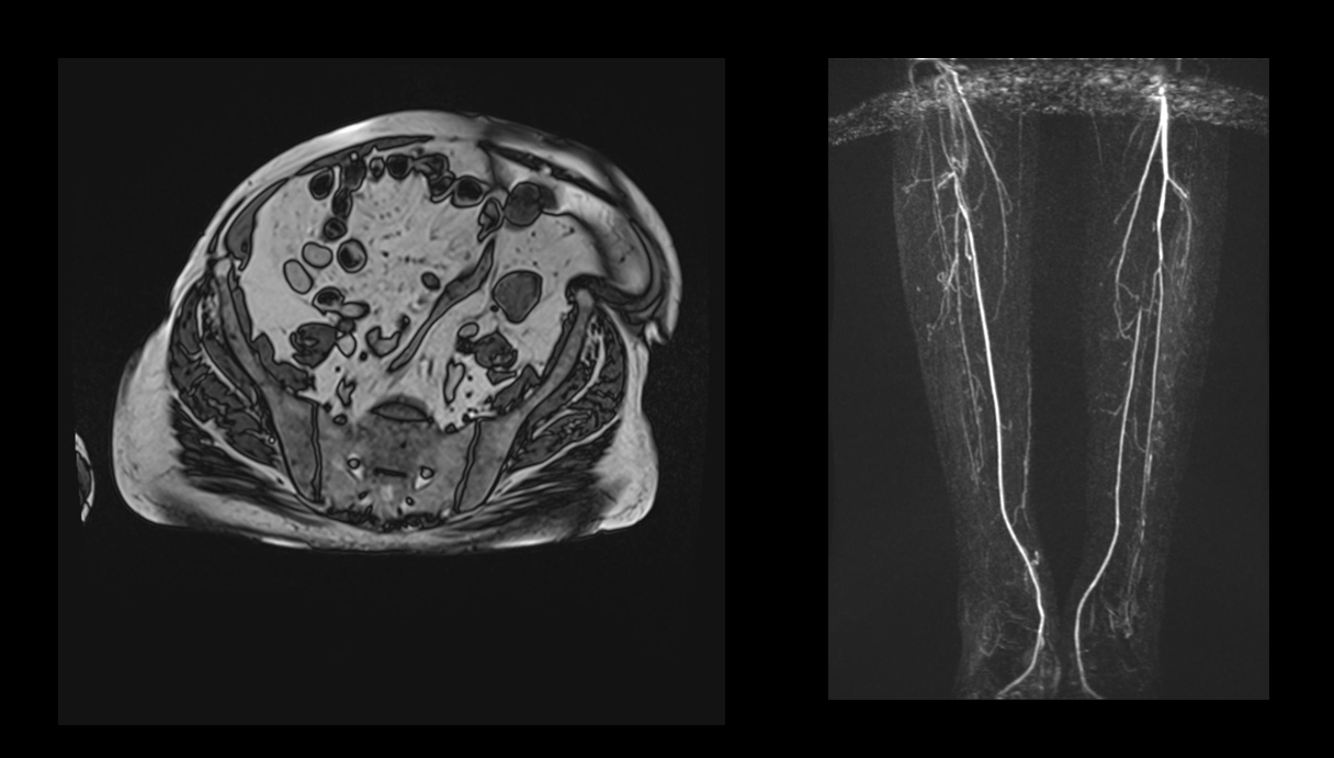 ATP de FeSup distal + Pop com implante de Stent recoberto Viabahn 