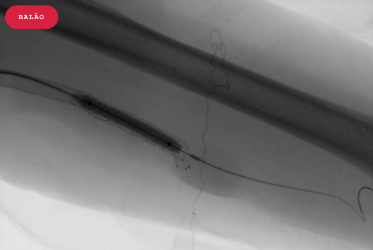 ATC de FAV com implante de stent-graft