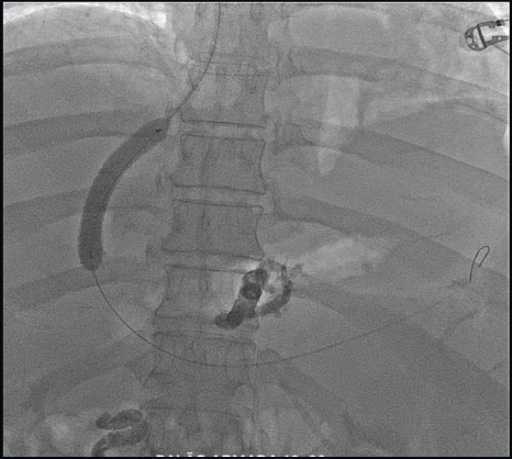 Angioplastia de TIPS + Implante de Stent Hepático + Embolização de varizes ectópicas duodenais